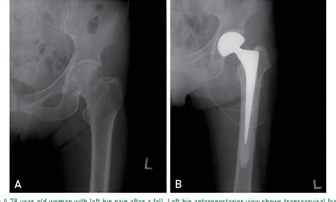 Femoral Neck Fracture Cemented Bipolar Hemiarthroplasty.